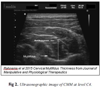 ultrasound cervical multifidus